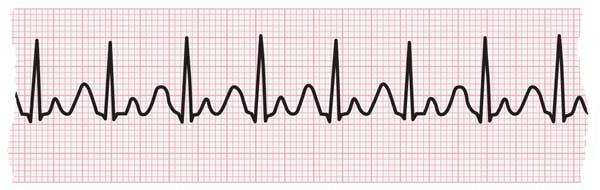 ECG strip showing tachycardia